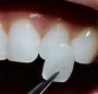 Dental Porcelain Veneers Service In South Africa