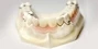 Cast Metal Partial Dentures In South Africa