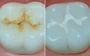 Pit Fissure Sealants Dentist In South Africa